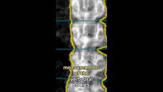 Opportunistic Bone Mineral Density Measurement Using PCD CT Spectral Localizer Images