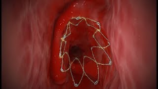 PROPEL® (mometasone furoate implant) Animation
