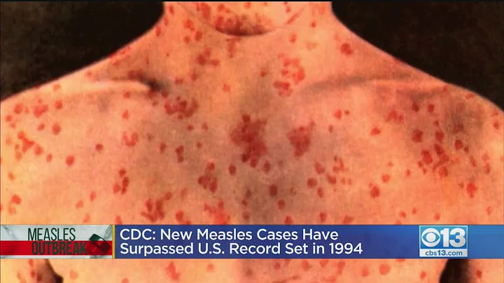CDC: US Measles Cases Reach Highest Number In Nearly Three Decades