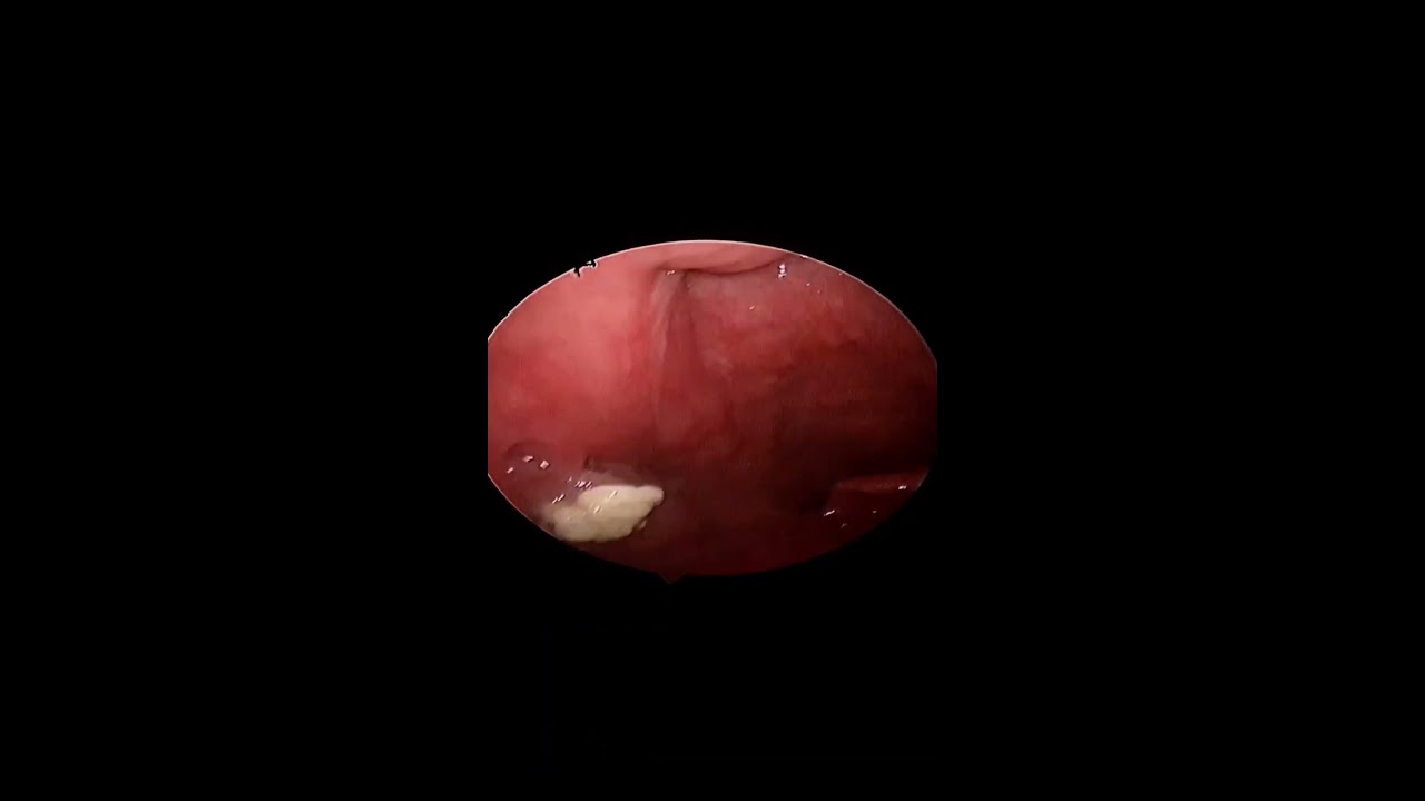 Removing A Large Tonsil Stone 