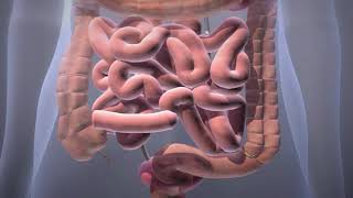 What is Urostomy?