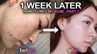 How I FIXED my ACNE & RED MARKS in 1 week (PART 2)