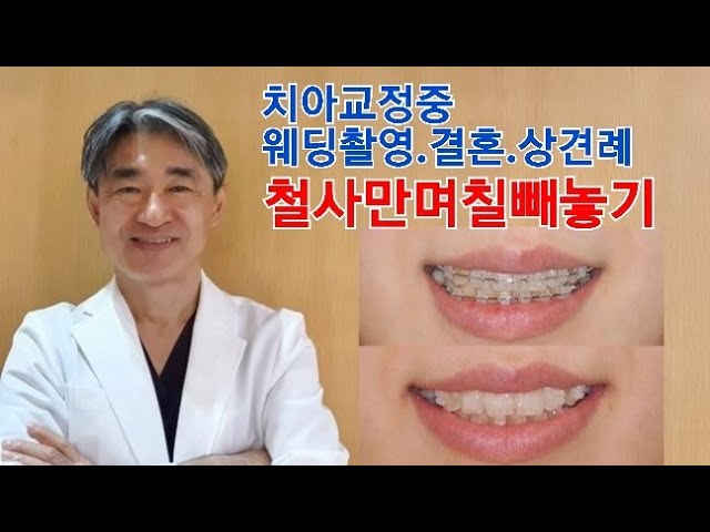 #치아교정 #교정중웨딩촬영 #치아교정기간  🤔치아교정중 웨딩촬영. 결혼. 상견례 위해서 교정철사 며칠만 빼놓기 (강남역 닥터프라임치과)
