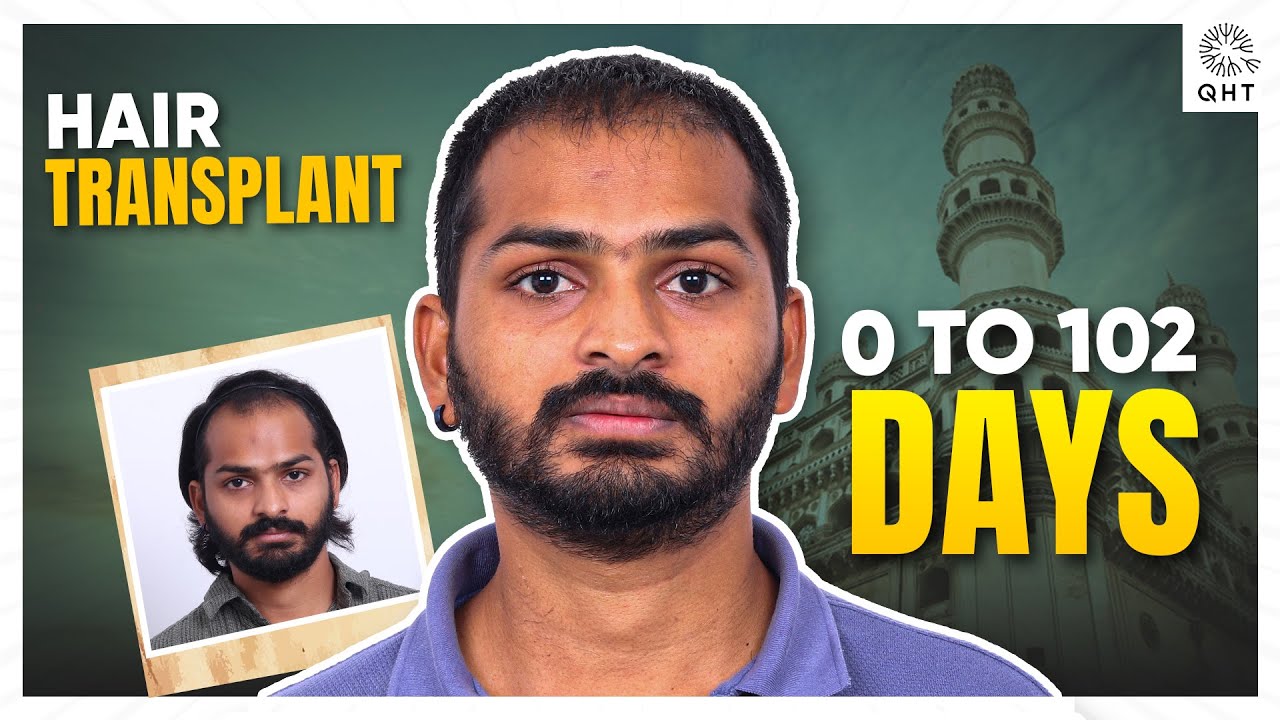 Hair Transplant in Salem (HX-SOCu) | Best Results & Cost of Hair Transplant in Salem