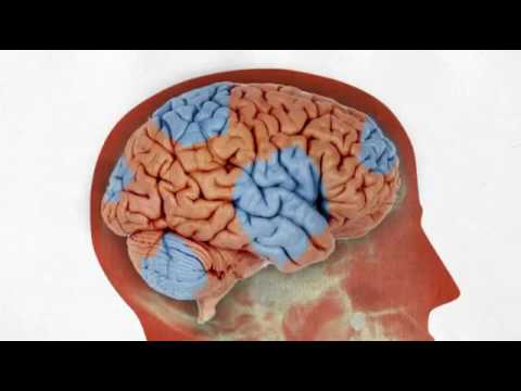 Video: Algemene Tekens Van Seniele Demensie (demensie)
