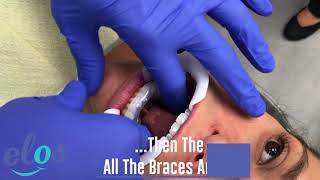 How Are Lingual Braces Placed?