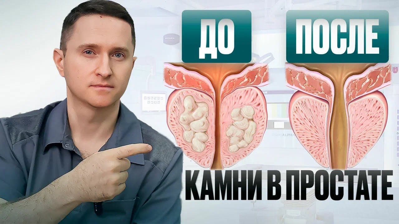 Как понять, что у тебя КАМНИ в простате?