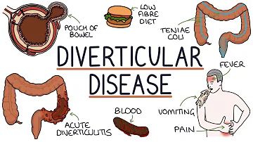 ¿Cuál es la gravedad de la diverticulitis?