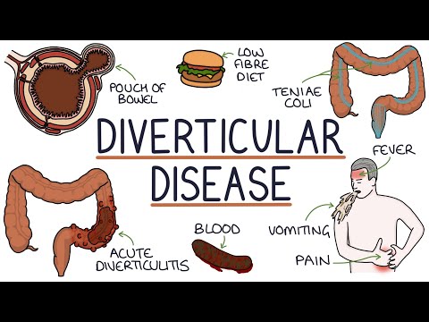 Video: Diverticula of the large intestine