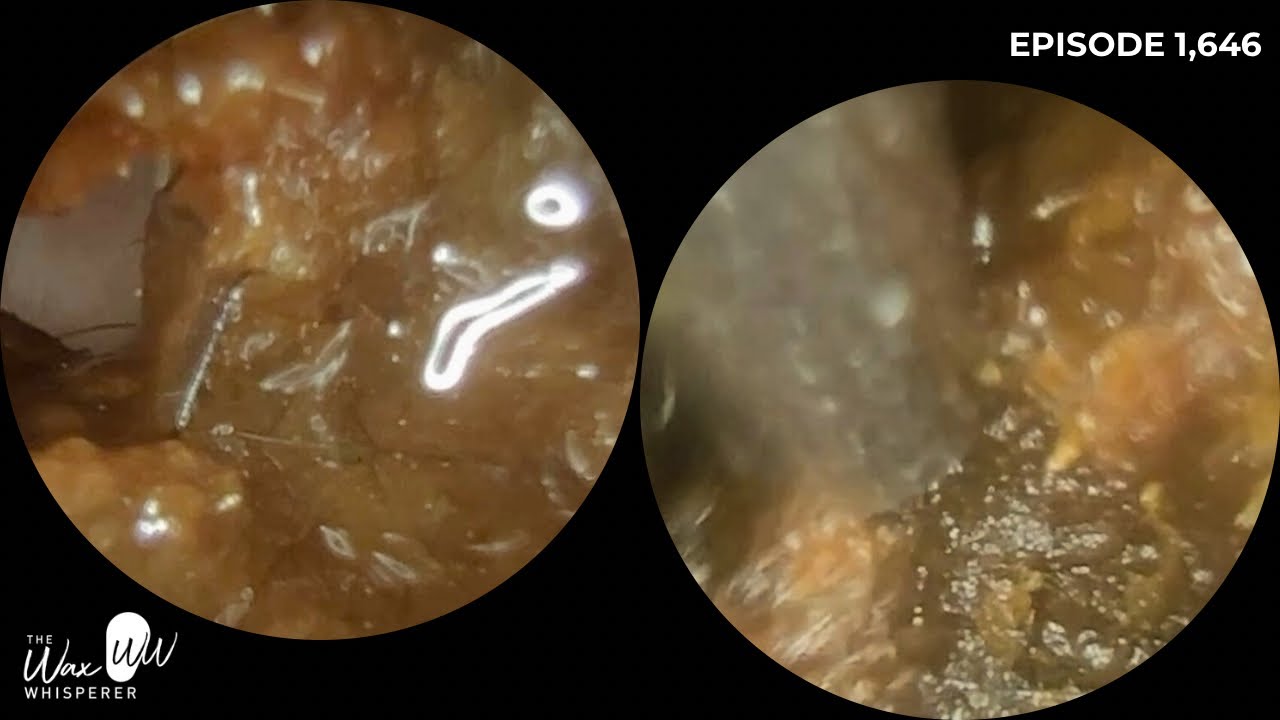 1646 — удаление ушной серы в Лестере в клинике Hear Clinic