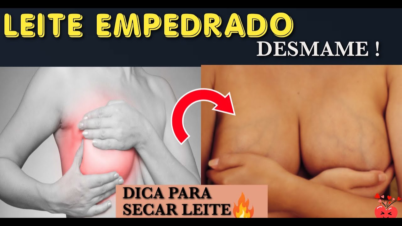 COMO SECAR LEITE DO PEITO EMPEDRADO |DESMAME