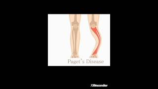 Osteitis Deformans/Paget's disease of Bone