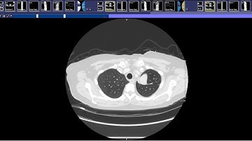 Basics of Oncologic Staging and Restaging / RECIST