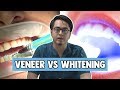 Veneer vs Whitening