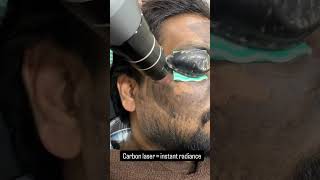Glow Like Never Before | Carbon Laser Treatment | DERMARADIANT CLINIC (200526) #skincare