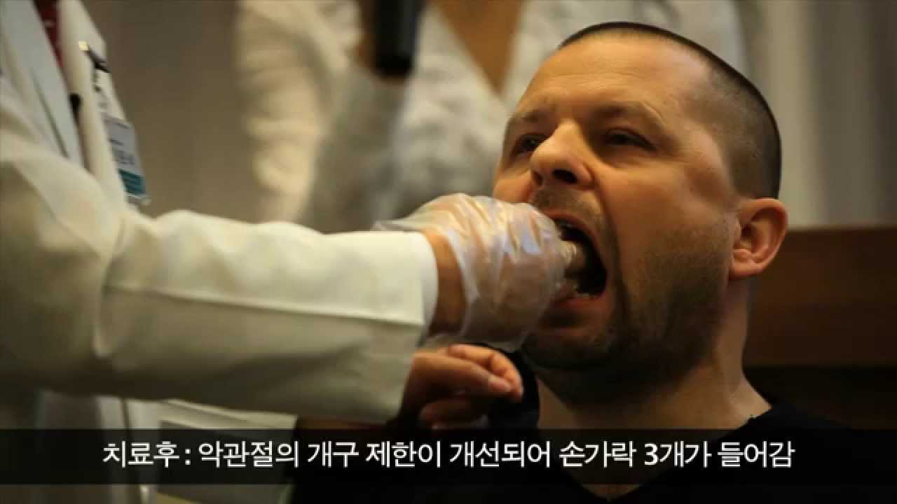 입을 시원하게 벌릴 수도 없었던 러시아 턱관절 환자