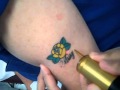 Laser Tattoo Removal: Dr. Bentkover, Candela TriVantage, Worcester and Stoneham  MA, New England