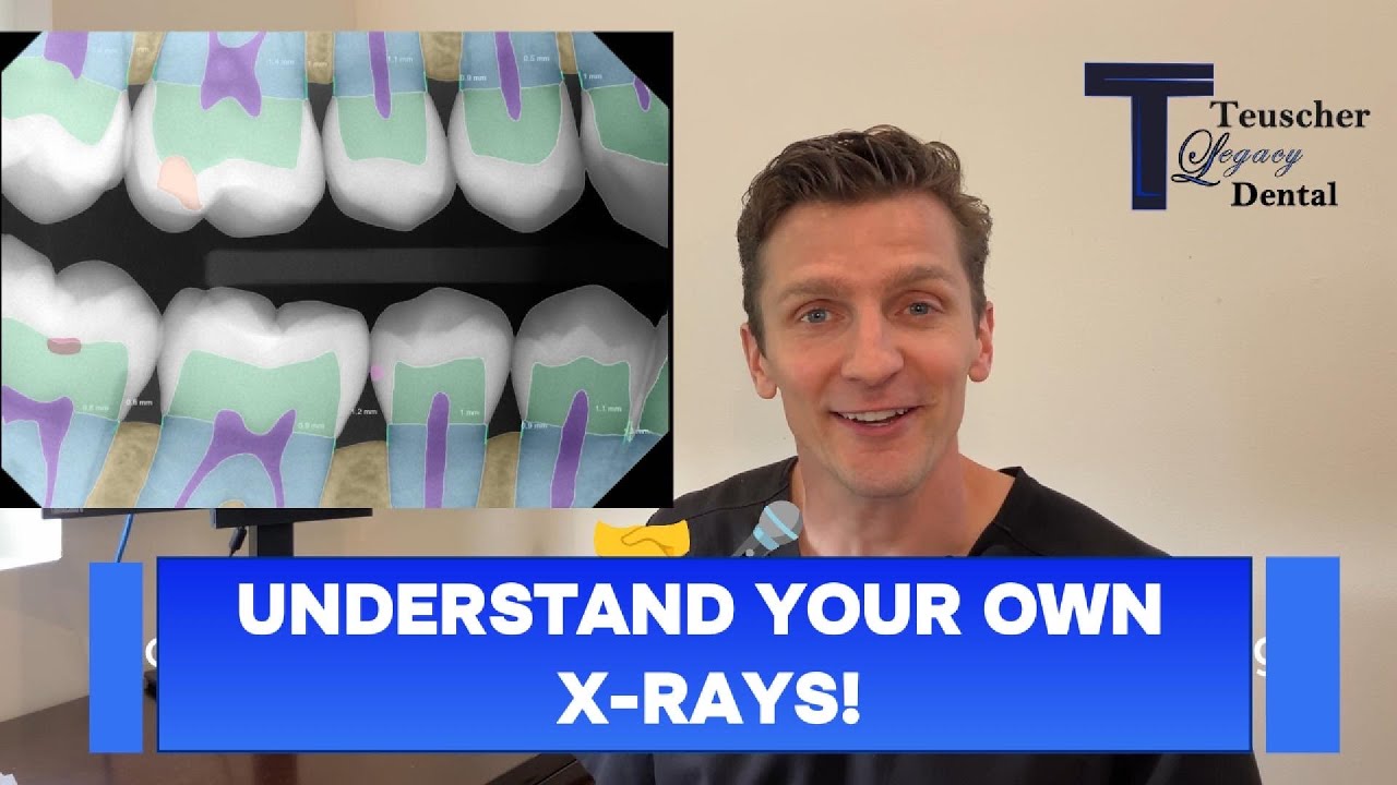 Video: Dr. Brayden Teuscher showing how AI-assisted software highlights findings on a dental X-ray