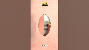 How does a craniectomy operation performed? — Part 1