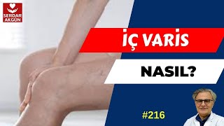 Varis neden olur? İç varis nedir? Varis tedavisi nasıl yapılır? Doktor Serdar Akgün