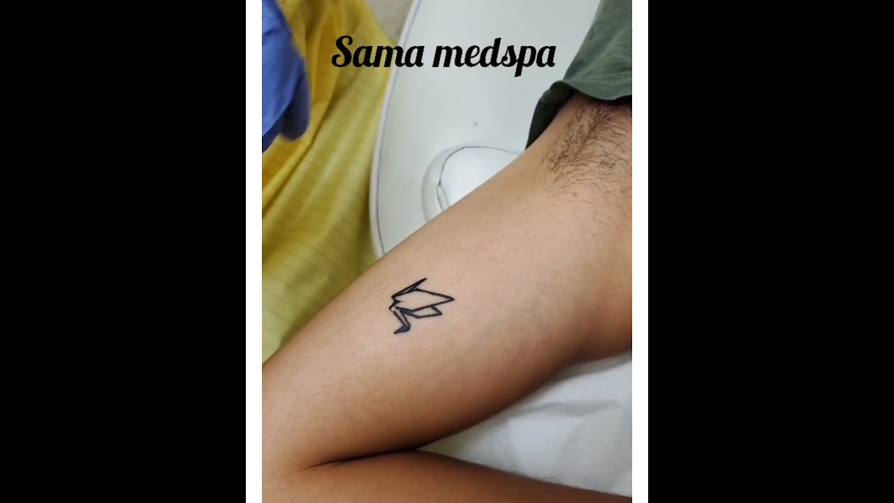 Laser Tattoo Removal Mississauga Canada / Booking via www.samaspa.ca/ Or Call 4372173350