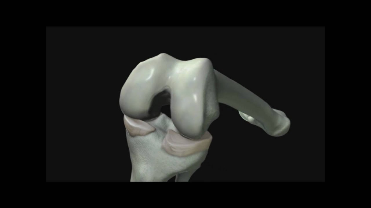 Knee Replacement YouTube