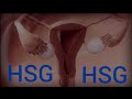 001 HYSTEROSALPINGOGRAPHY HSG CLINICAL RADIOLOGY GENERAL RADIOLOGY DANIEL M WASSEL