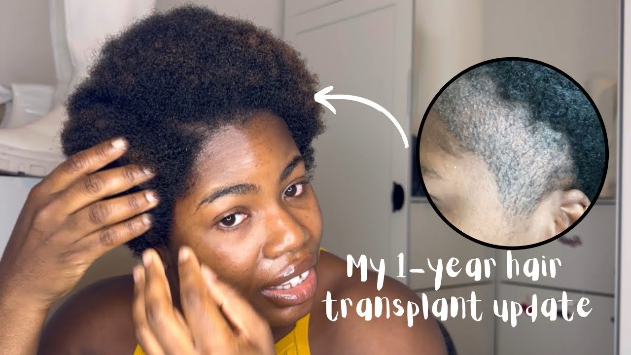 Is this the cure for your balding edges? My 1-year hair transplant update | Logevita Turkey
