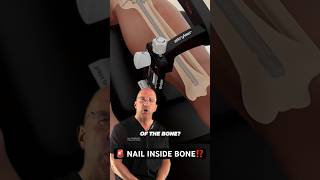 Aggressive Fracture Repair 🛠️ Driving Nail Into Bone #shorts