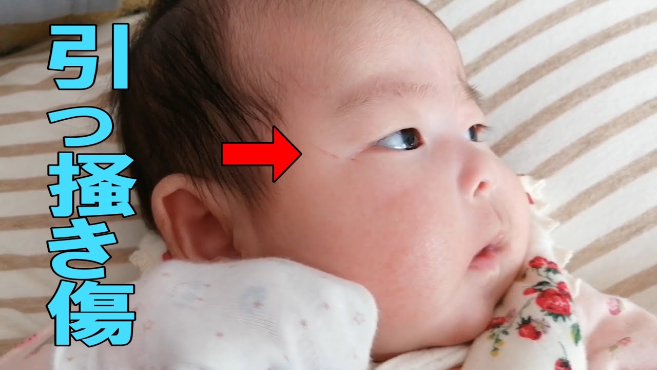 赤ちゃんの顔に傷ができてしまいました Youtube 赤ちゃんの顔に傷ができてしまいました Youtube
