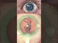 Как вернуть зрение при катаракте?