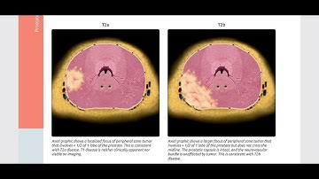 Introduction to Prostate MRI and PI-RADS: Approach and Principles ‎@RadiologyChannel 