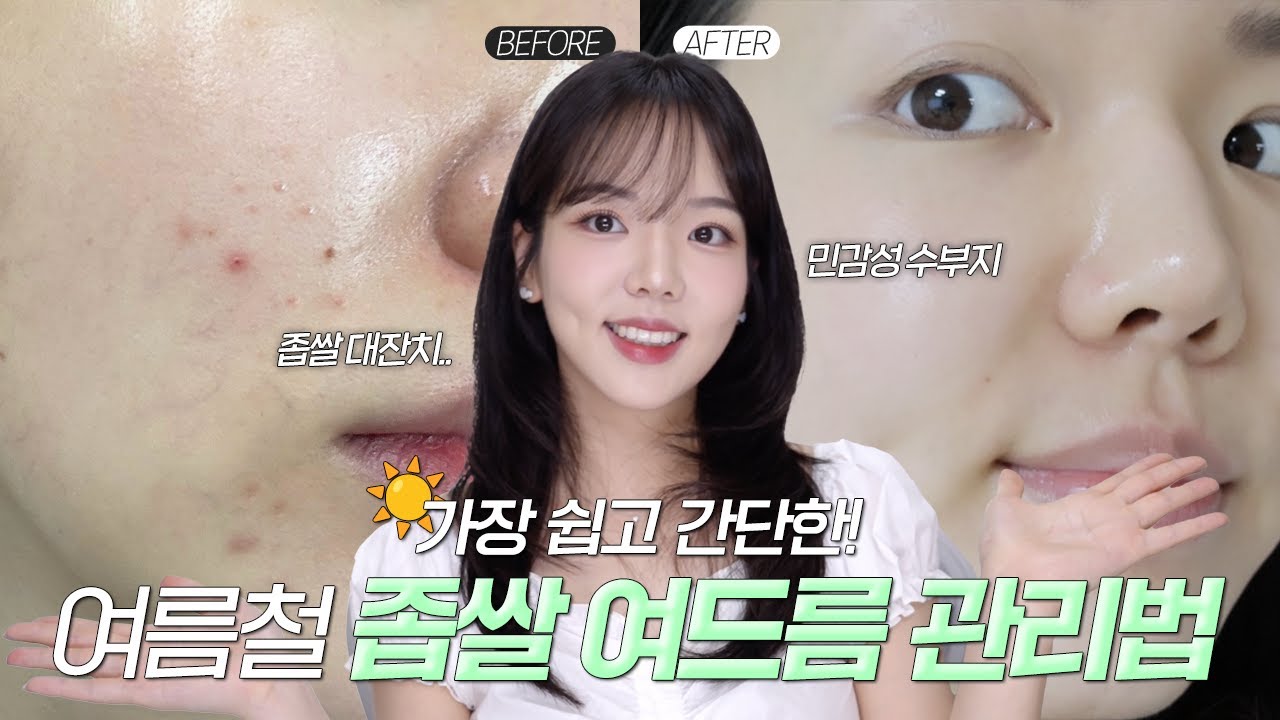 이걸 모른다고..? 여름철 좁쌀 여드름 없애는 생활 속 습관 4가지🫢