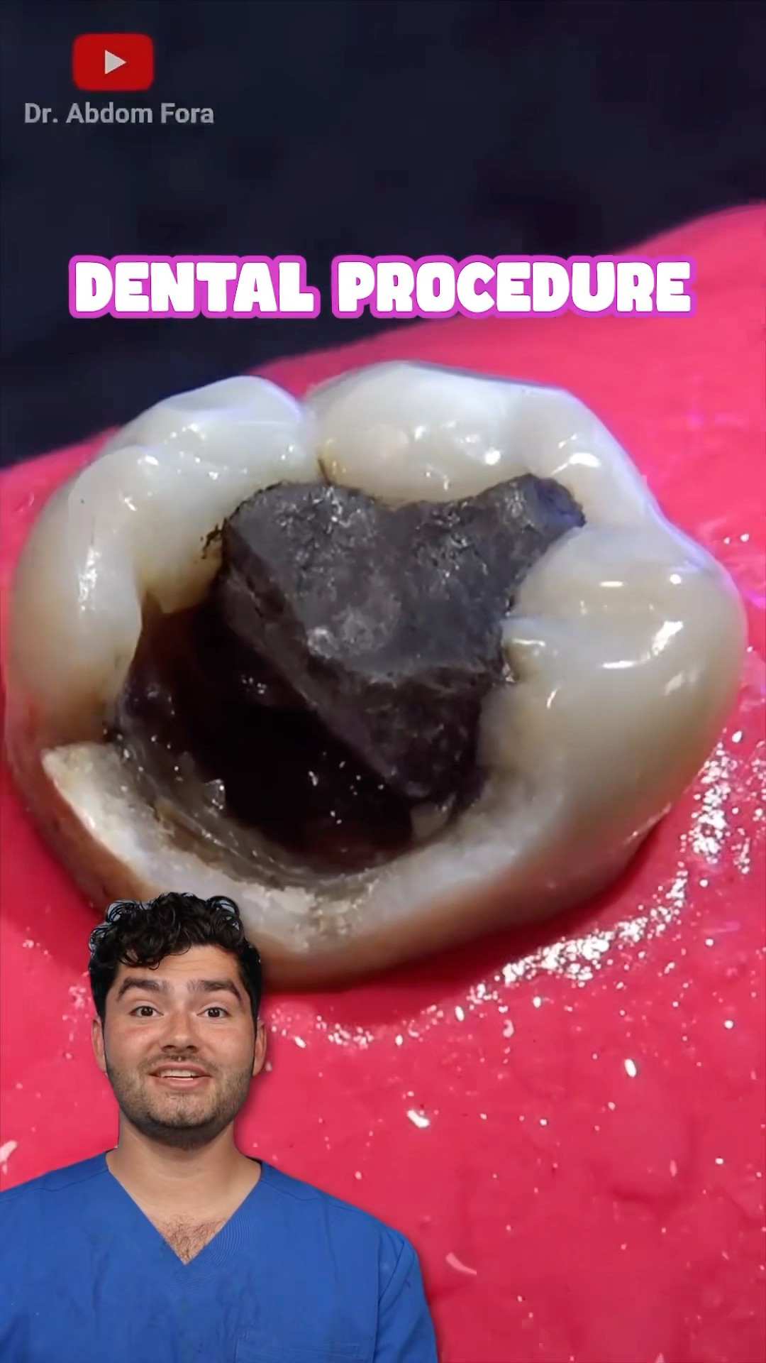 Dental Filling Explained !?