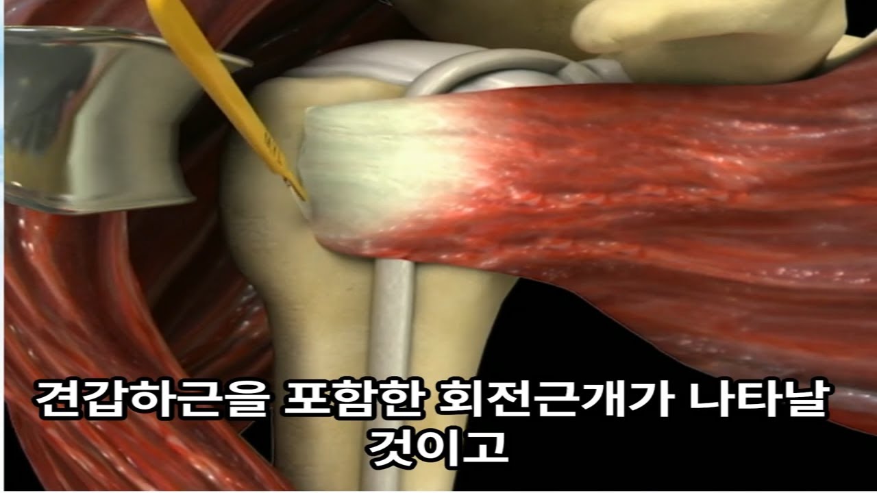 어깨 힘줄 파열 회전근개 파열 : 원인, 과정, 평가와 관리 - YouTube