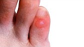 How to Get Rid of Corns on Toes Fast - YouTube