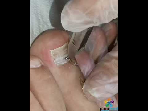 Ətə batan dırnağın Podofix skobaları ilə düzəldilməsi