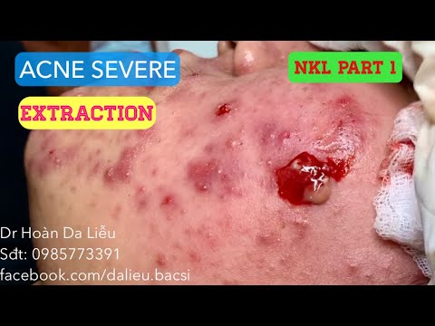 Mụn trứng cá mủ viêm cực nặng|Dermatologist,pimples,whitehead,acne severe extraction NKL part 1