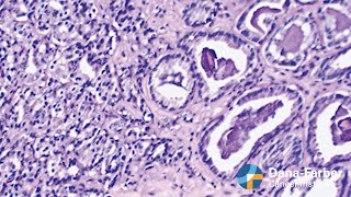 Prostate cancer on the rise | Dana-Farber Cancer Institute