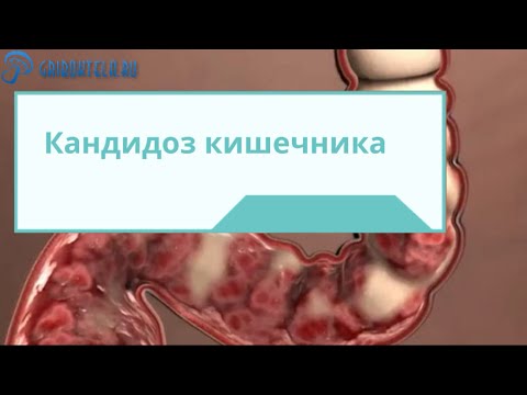 Кандидоз кишечника: виды, симптомы, диагностика и лечение болезни