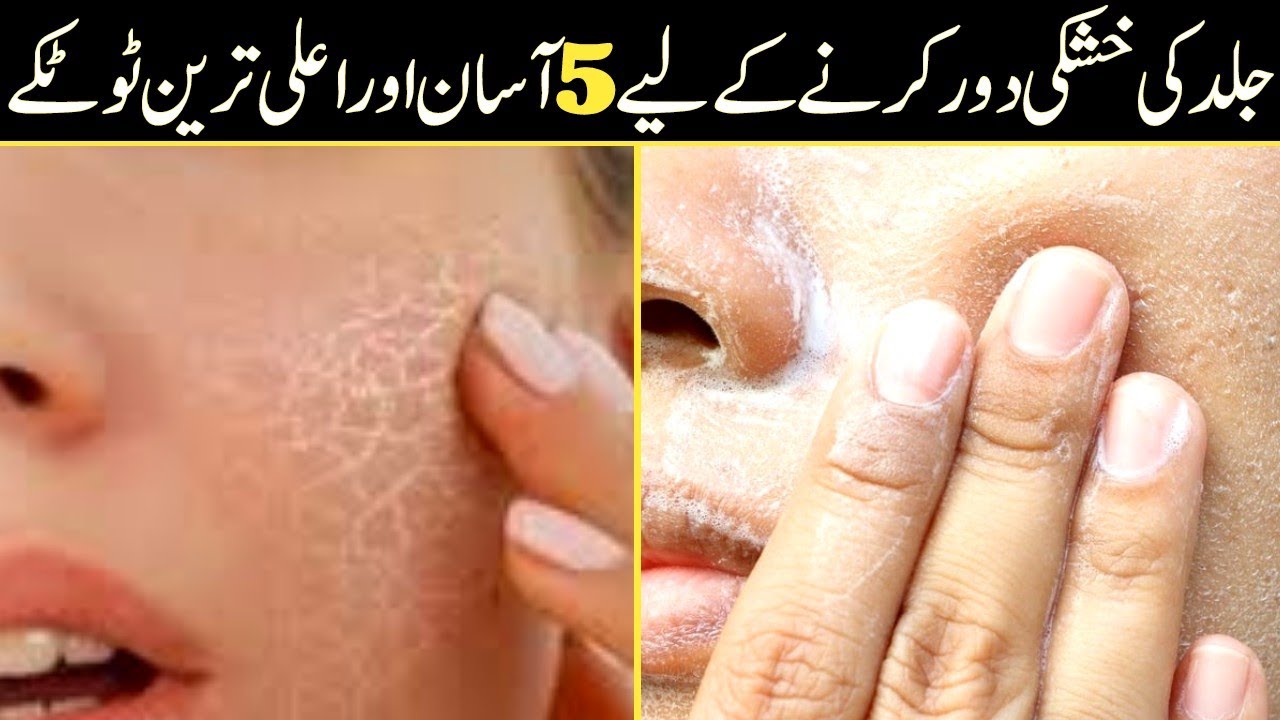 Jild ki Khushki ka ilaj In Urdu Dry Skin Causes & Treatment At Home