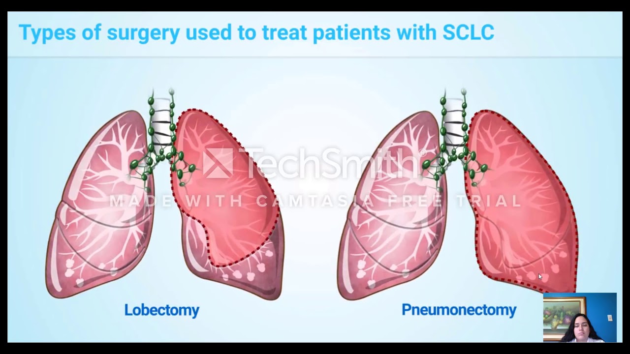 Small cell lung cancer stage 3