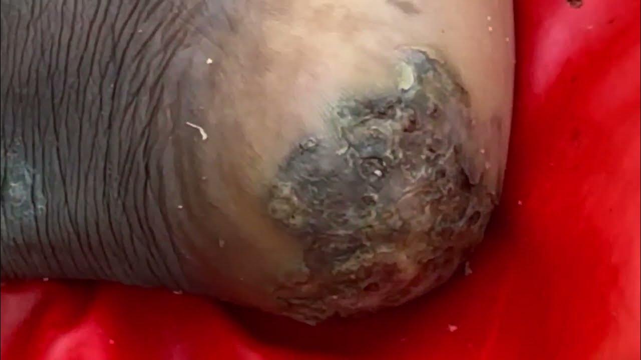 Nicolas jigger dug big rotting jiggers and dead skin YouTube