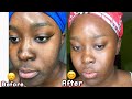 Faded acne scars dark spots and cleared skin fast w/ proof in video (SEP 2018-NOV 2019)| jwillscool