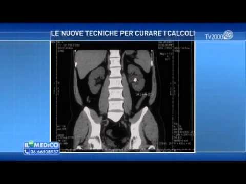 Video: Calcoli Renali Di Acido Urico - Come Dissolversi? 7 Regole