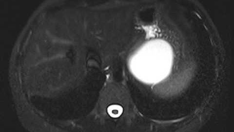 Gastric duplication cyst