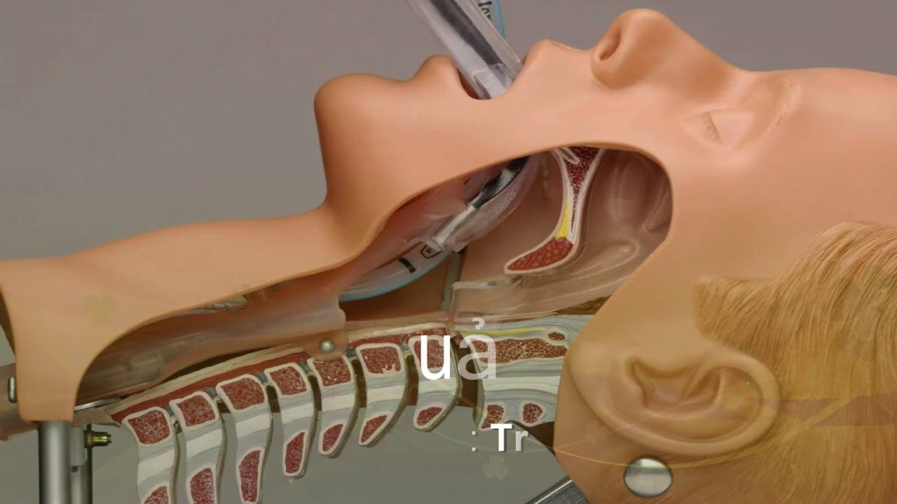 Трубка при наркозе. Интратрахеальный наркоз.
