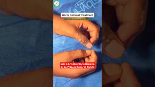Wart Removal in Minutes👏Safe &amp; Precise Treatment at Ranchi Advance Skin Center#wartremoval #skindoc