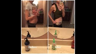 My Laparatomy Ovarian Cystectomy Story | Nicole Danielle Acosta