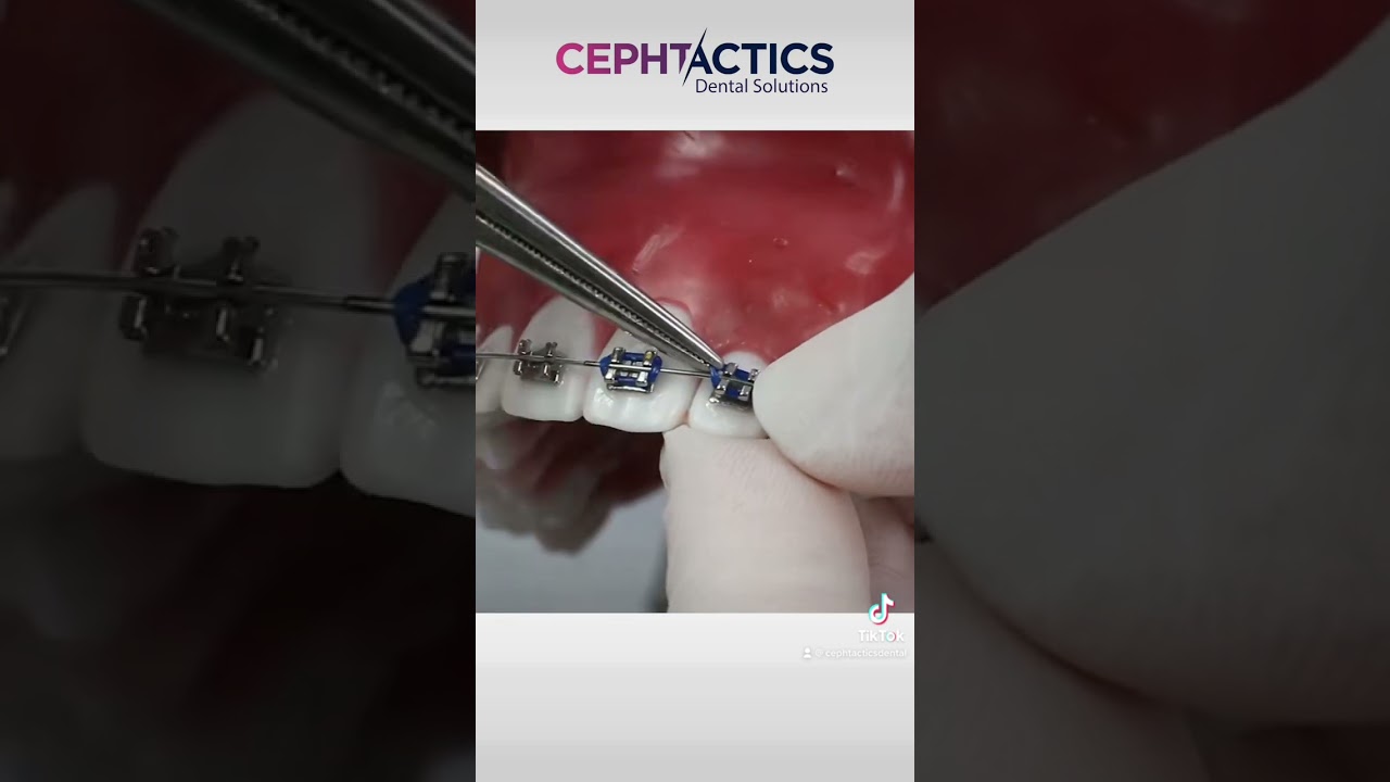 How to place modules or elastic ligatures on fixed braces?